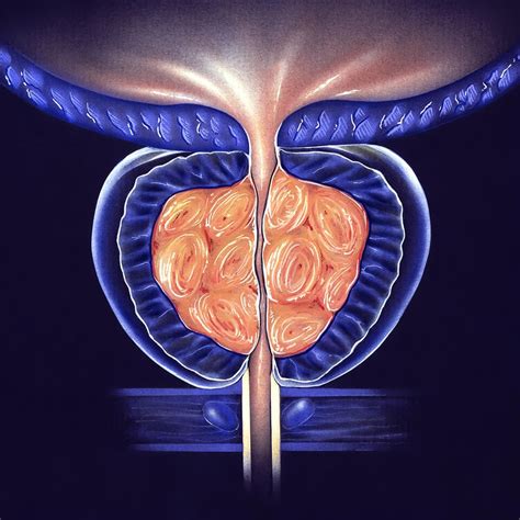 Benign Prostatic Hyperplasia (BPH) .